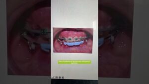 ortodoncia niños seguridad social